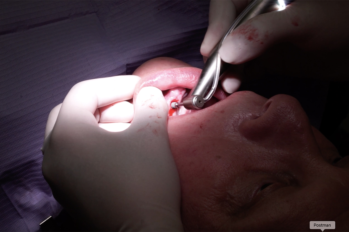 Cirugía Oral y Colocación de Implantes en Sevilla